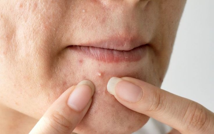 Phân biệt – Nhận diện các tình trạng mụn